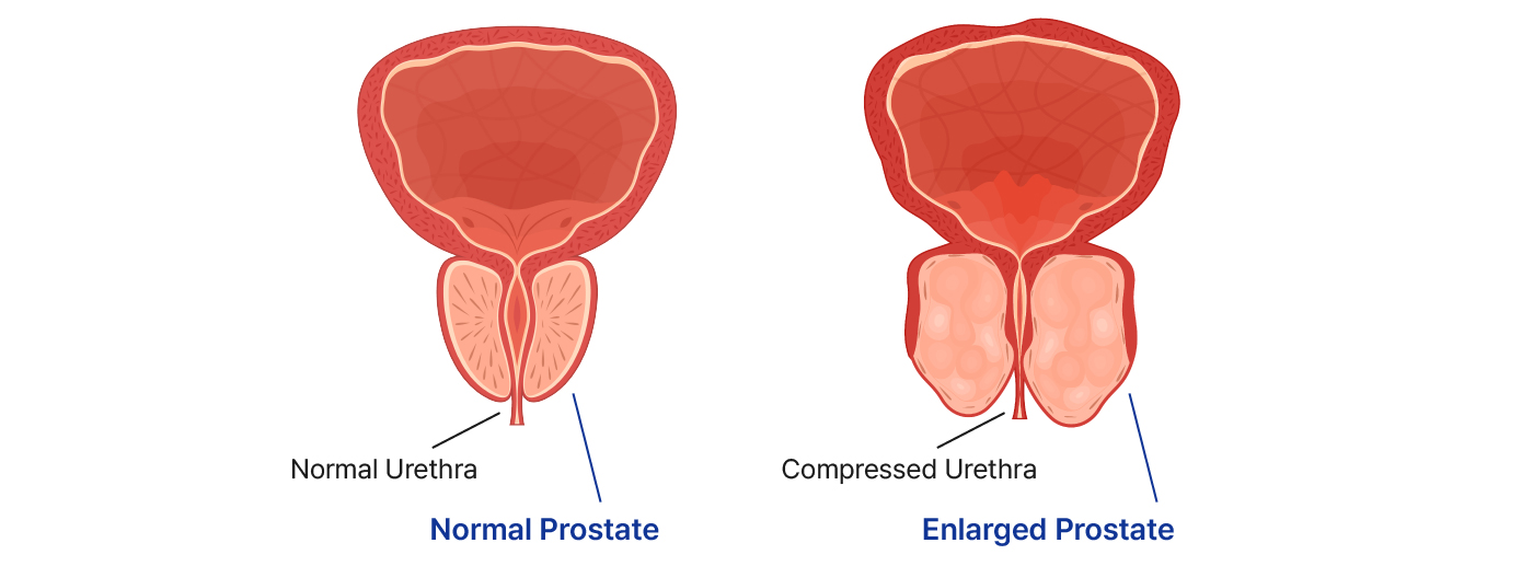 BPH Illustration